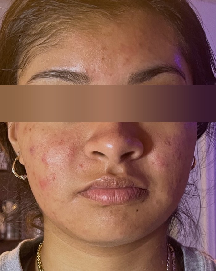 Antes del tratamiento facial
