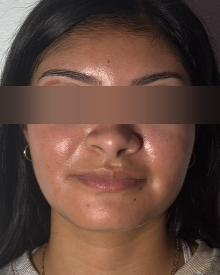 Después del tratamiento facial